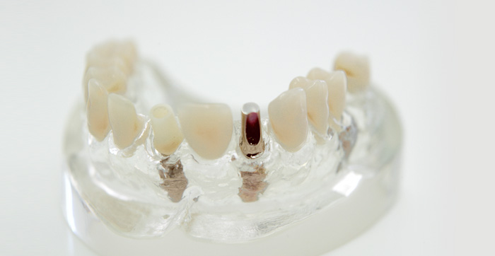 Implantologie bei Ihrem Oralchirurgen in Grünwald